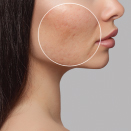 acne on woman's face